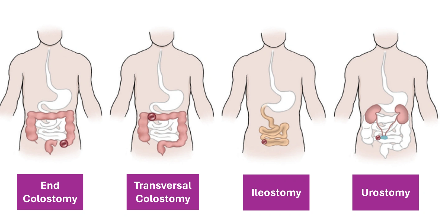 Ostomy Care Guide: From Concern to Confidence - Pexol